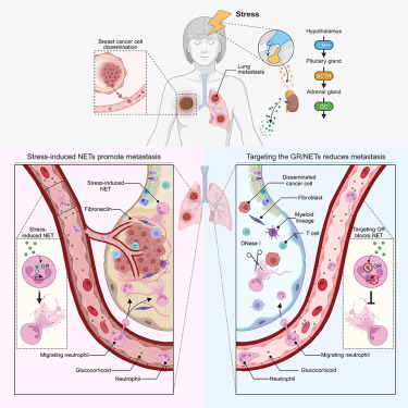 Cancer_Cell's tweet image. Online Now: Chronic stress increases metastasis via neutrophil-mediated changes to the microenvironment dlvr.it/T38g34