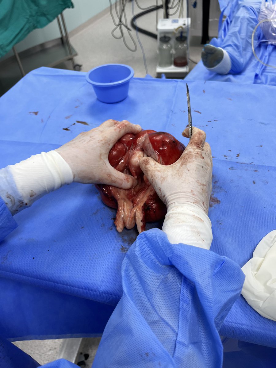 barri_graham's tweet photo. We removed a huge uterus with fibroids https://t.co/iytnTek1ZF