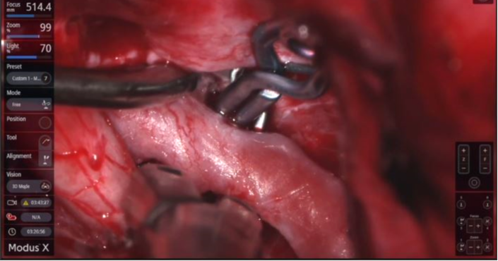 SynaptiveMed's tweet photo. The Department of Neurosurgery at Allegheny General Hospital featured its use of Synaptive's #roboticexoscope #ModusX in the JNS Neurosurgical Focus Video issue. They performed a pineal tumor resection and an SHA aneurysm clipping. Watch the cases here: https://t.co/rLA3fmT81g https://t.co/Ok8xwCibEw