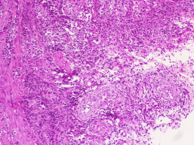 ariella8's tweet photo. 2/ / #GIPath #Colonicpolyps #Hemepath ?
3 mm rectal polyp ,surprise 😯
What is your favored DX morphologic basis?
There are eos, capillaries, and mitotic activity
IHC request?
See the first set
@sanamloghavi @mjcascio @KarrsJeremiah https://t.co/Z8IEXthyr4