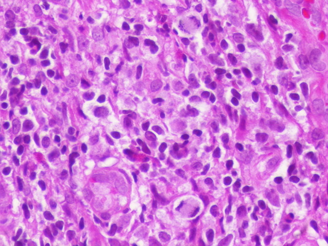 ariella8's tweet photo. 2/ / #GIPath #Colonicpolyps #Hemepath ?
3 mm rectal polyp ,surprise 😯
What is your favored DX morphologic basis?
There are eos, capillaries, and mitotic activity
IHC request?
See the first set
@sanamloghavi @mjcascio @KarrsJeremiah https://t.co/Z8IEXthyr4