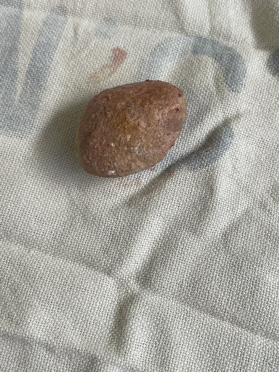 Removed this stone from a 2 yr old boy’s bladder. Family requested to see what was removed & we gave it to them. 
Told them to hydrate lest they end up the same. When we left theatre everyone had a bottle of water😂😂. 
Seen alot of cases of urolithiasis over the past few days.…