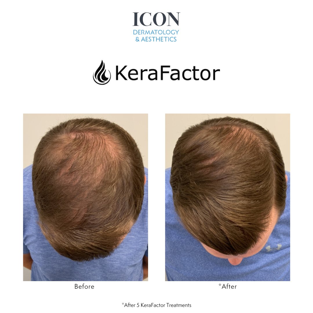 During KeraNeedling treatment, we make very small micro-channels on your scalp and simultaneously deliver the KeraFactor serum which will enhance the functionality of your hair follicles and improve the thickness and quality of your hair.
📞301-810-3600
#hairgrowth #thinninghair