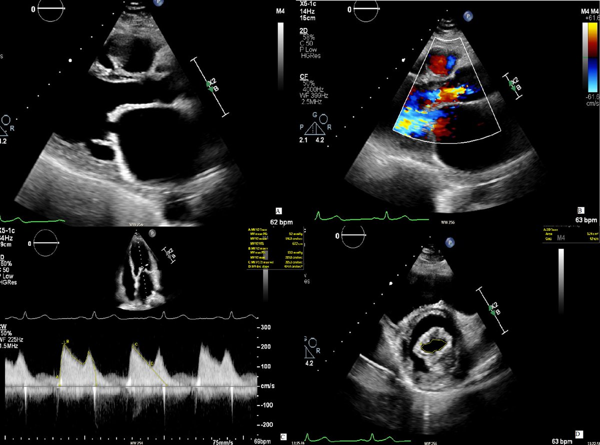 🔴 Non-Invasive Assessment of Multivalvular Heart Disease: A Comprehensive #2024Review #openaccess 

✅imrpress.com/journal/RCM/25…

#CardioEd #CardioTwitter  #2024Review #cardiovascular #CardiacHealth #MedTwitter  #Cardiology #MedEd #CardioEd #CardioTwitter