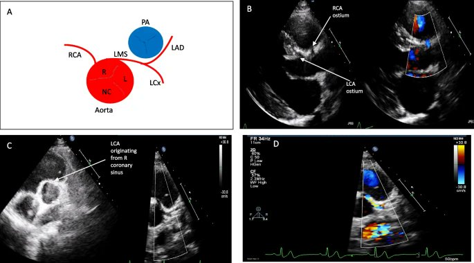 🔴 Coronary artery anomalies and the role of echocardiography in pre-participation screening of athletes: a practical guide #2024Review #openaccess echo.biomedcentral.com/articles/10.11… #cardiology #CardioTwitter #CardioEd #MedEd #medtwitter #cardiovascular