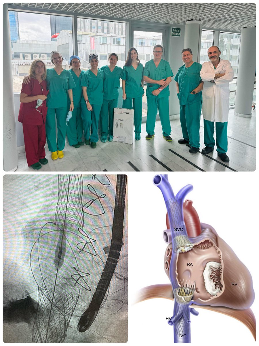 World Medica (@worldmedica) on Twitter photo Dos nuevos casos de #IT severa se suman a la serie de pacientes implantados con la solución CAVI #Tricvalve. Enhorabuena al Hospital Universitario la Paz y a <a href="/Hemodin_LaPaz/">Hemodinamica_LaPaz</a> por su programa tricúspide. Mención a los Dres.<a href="/RaulmorenoMD/">Raul Moreno</a>,<a href="/hemodin90/">Guillermo Galeote</a> #SantiagoJiménez, y <a href="/ari_gonzalvez/">Ariana Gonzálvez</a> Dos nuevos casos de #IT severa se suman a la serie de pacientes implantados con la solución CAVI #Tricvalve. Enhorabuena al Hospital Universitario la Paz y a <a href="/Hemodin_LaPaz/">Hemodinamica_LaPaz</a> por su programa tricúspide. Mención a los Dres.<a href="/RaulmorenoMD/">Raul Moreno</a>,<a href="/hemodin90/">Guillermo Galeote</a> #SantiagoJiménez, y <a href="/ari_gonzalvez/">Ariana Gonzálvez</a>