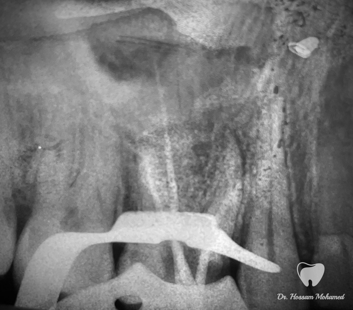 HossamMkhalaf's tweet photo. Endodontic treatment for upper left 6 with 4 canals 🦷👌
MB2 is type II 
الحمد لله ❤️ https://t.co/u1fZN5lUMm