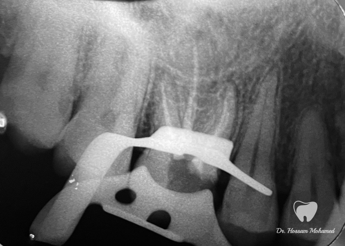 HossamMkhalaf's tweet photo. Endodontic treatment for upper left 6 with 4 canals 🦷👌
MB2 is type II 
الحمد لله ❤️ https://t.co/u1fZN5lUMm