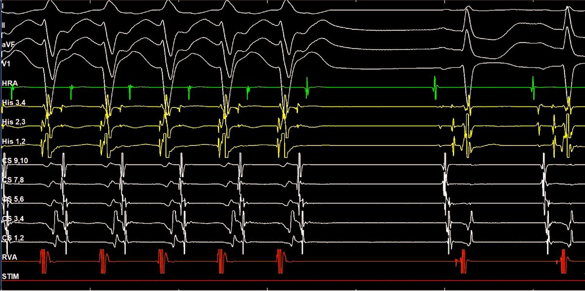An EP 💎gem

Referred from OSH (2 x R slow pathway modification) for recurrent tachycardia

Where was the successful site of ablation? #EPfellows #Epeeps #TeachtoLearn 

Poll below 👇