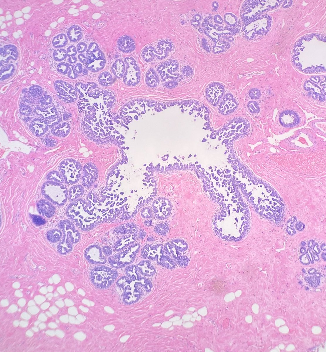 Micropapillary ductal carcinoma in situ involving a camel 🐫 Accepting contributions for my future Atlas of Emojis in Pathology!! Reply with yours!
