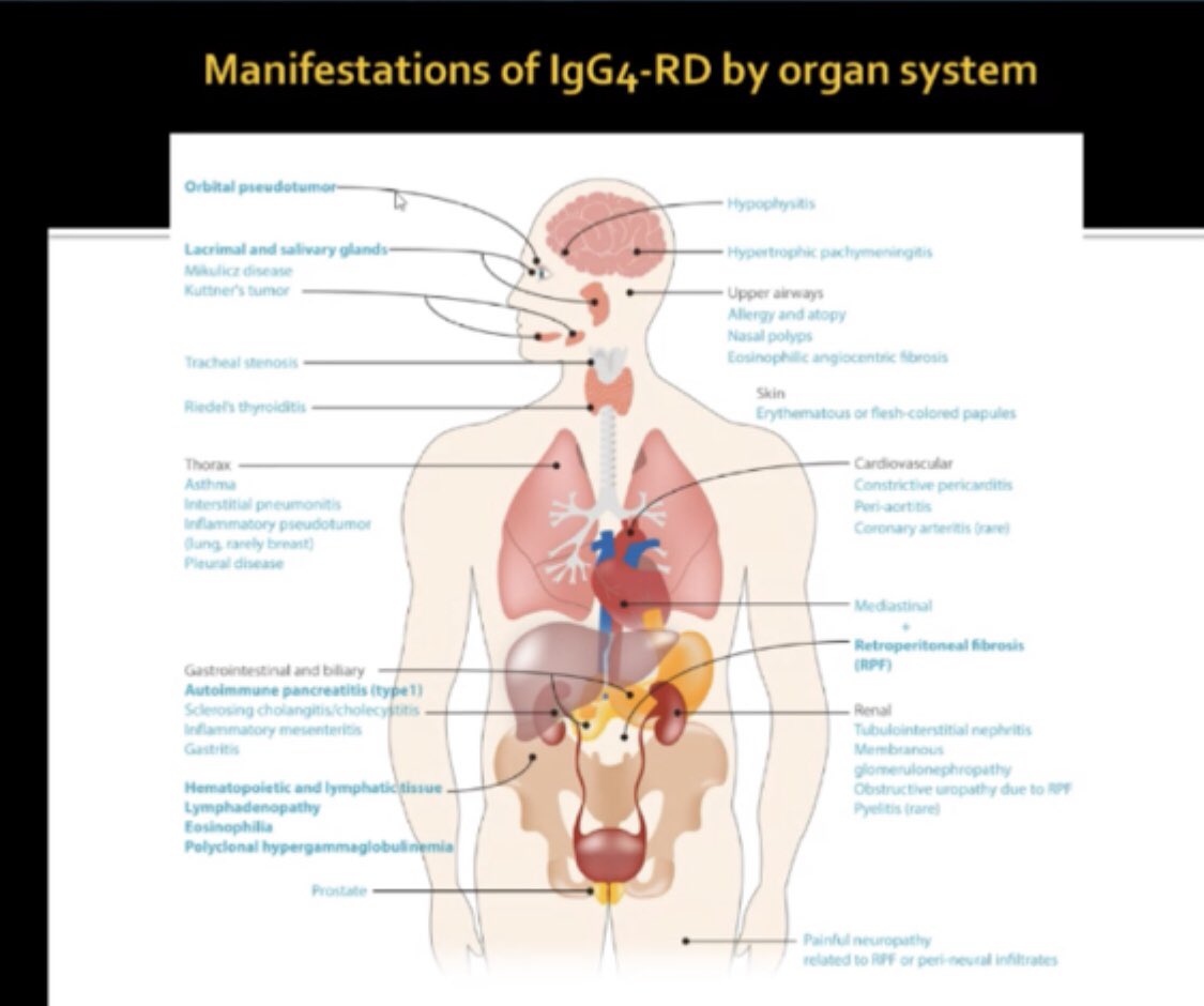 Janetbirdope's tweet image. #IgG4 #disease 

Need a #bx
Serum elevated IgG4 is NOT sufficient 

#RheumReview @CRASCRRheum