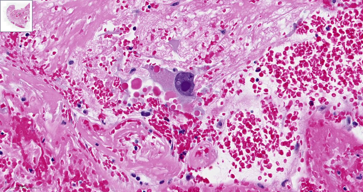 2/3. #ENTpath knew Twas a benign growth that grew… From sinus to back of throat, where it did reside. Its stellate stroma bizarre but benign, Joanna’s polyp was giving her jip, and Eosinophils lacking seemed not a classical SNIP…