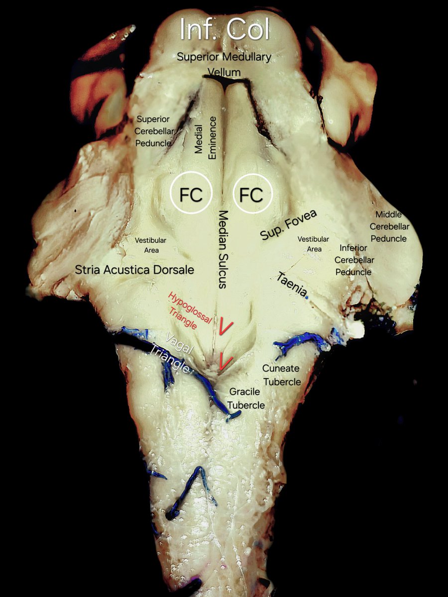 Unraveling the brimming surface anatomy found on the floor of the fourth ventricle, the dorsal aspect of the hindbrain. Done by our talented research fellow @RoccuzzoDiego @CleveClinicFL