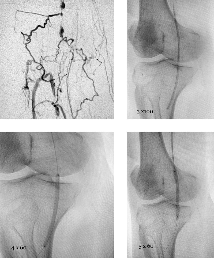 Case 31: with @BhaveshPopat7
.
CLI; pop occlusion; good distal BTK vessel run off; 
Mx: pop plasty+DEB; 4/5mm & 3mm at transition; images 👇
.
#irad #meded #MedTwitter #CardioTwitter #interventionalradiology #virad #radres #clifighters @CLIfighters @_backtable @VascularForum