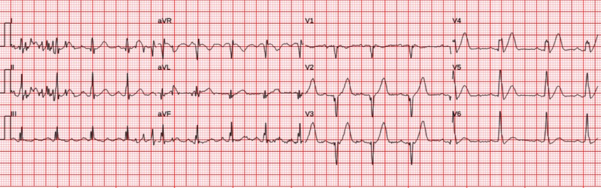 NeuroQuinn's tweet image. Sinus rhythm with HR ~100 /min 
Normal axis
Typical De winter T waves 
Imp: Old antero lateral MI ( LAD )

#CardioTwitter  #ECGAnalysis