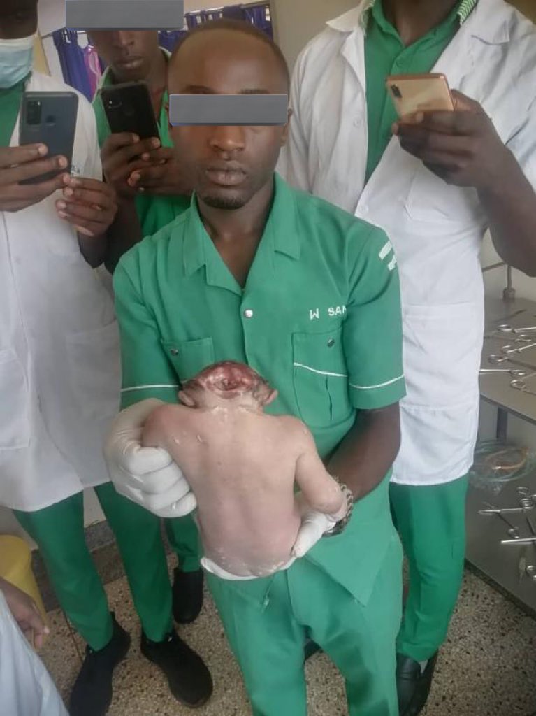 This is how your baby will turnout to look if you keep going to the sauna and steam baths while pregnant 😢

Also ladies ensure that you start on folic acid immediately after realizing you’re pregnant