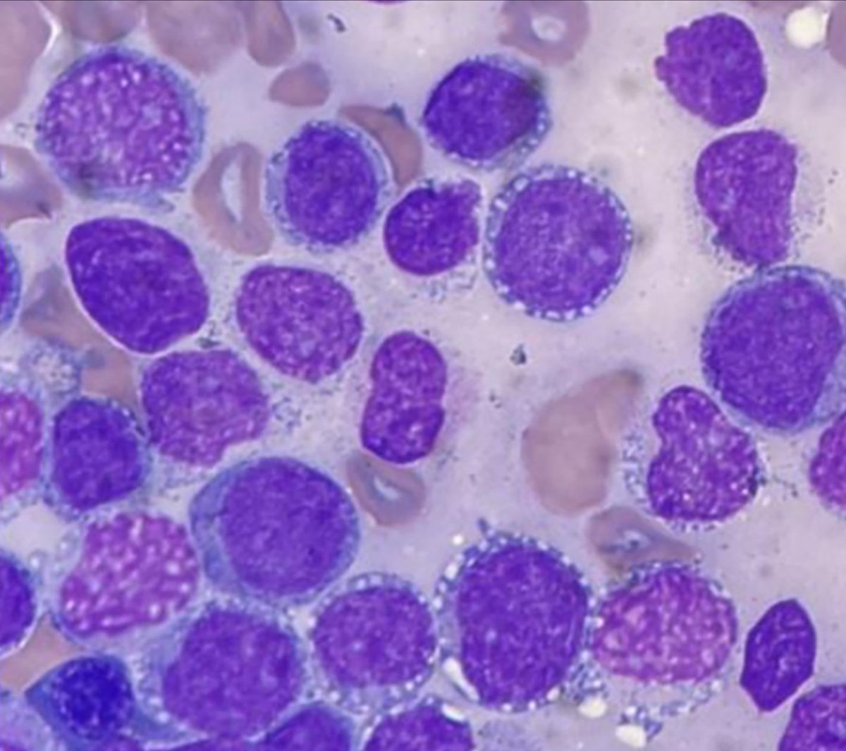 82/male/ presents with fever and a rash !

Blood counts are ⤵️ so he undergoes a bone marrow examination!

The blasts look like 👇🏼

On FCM they are + for CD4, CD56, CD123, HLA-DR and negative for CD34, MPO, CD19, CD10.

Diagnosis?
Management?

#MedTwitter 

Image: BJH