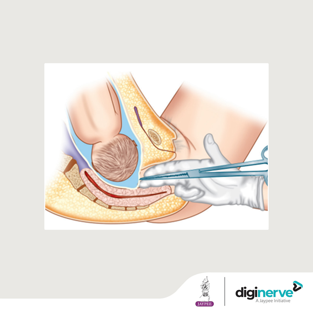 An OBGYN resident plans to perform the procedure given in the image on a 28-year-old female patient. What is the procedure?

a.Low rupture of membrane
b.Episiotomy
c.Burns-Marshall method
d.Lovset’s manoeuvre  

#DigiNerve #NerveCrackin #QuizTime #MedicalQuiz