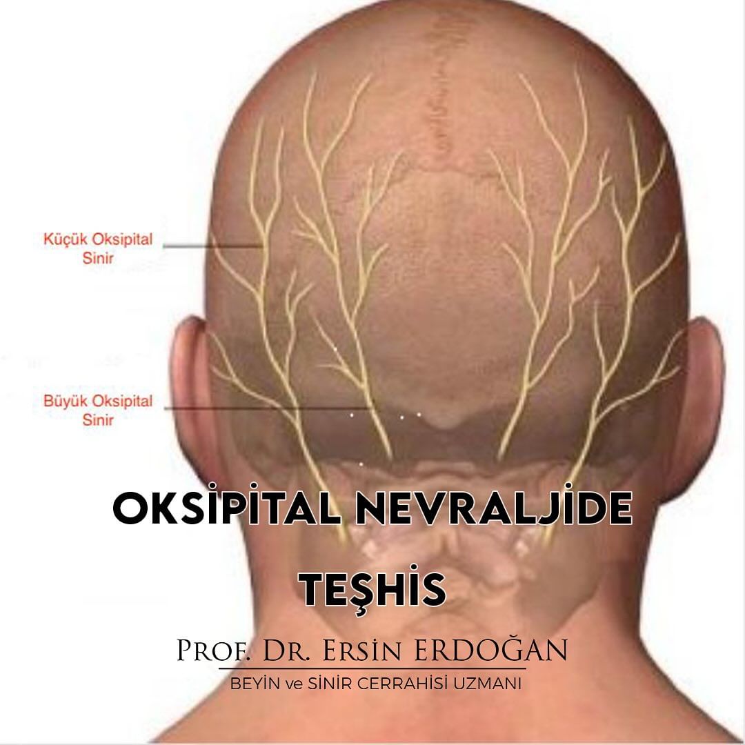 beyincerrahisi's tweet photo. Oksipital nevralji, başın arka kısmında yer alan oksipital sinirin sıkışması veya tahrişinden kaynaklanan bir durumdur. Genellikle başın arkasında veya ensede şiddetli elektrik çarpması yada yanma şeklinde bir ağrıya neden olur. Teşhis için genellikle bir doktora görünmek gerek https://t.co/sPbVkvPluG