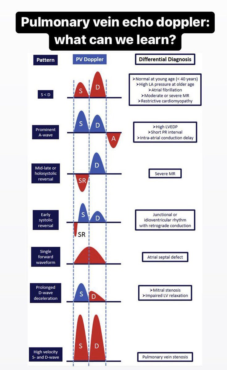 ~~ Pulmonary Vein Doppler 📕~~

We can glean a surprising amount of information from the pulmonary vein flow alone.. don’t ignore the pulmonary veins 👇
#echofirst ♥️