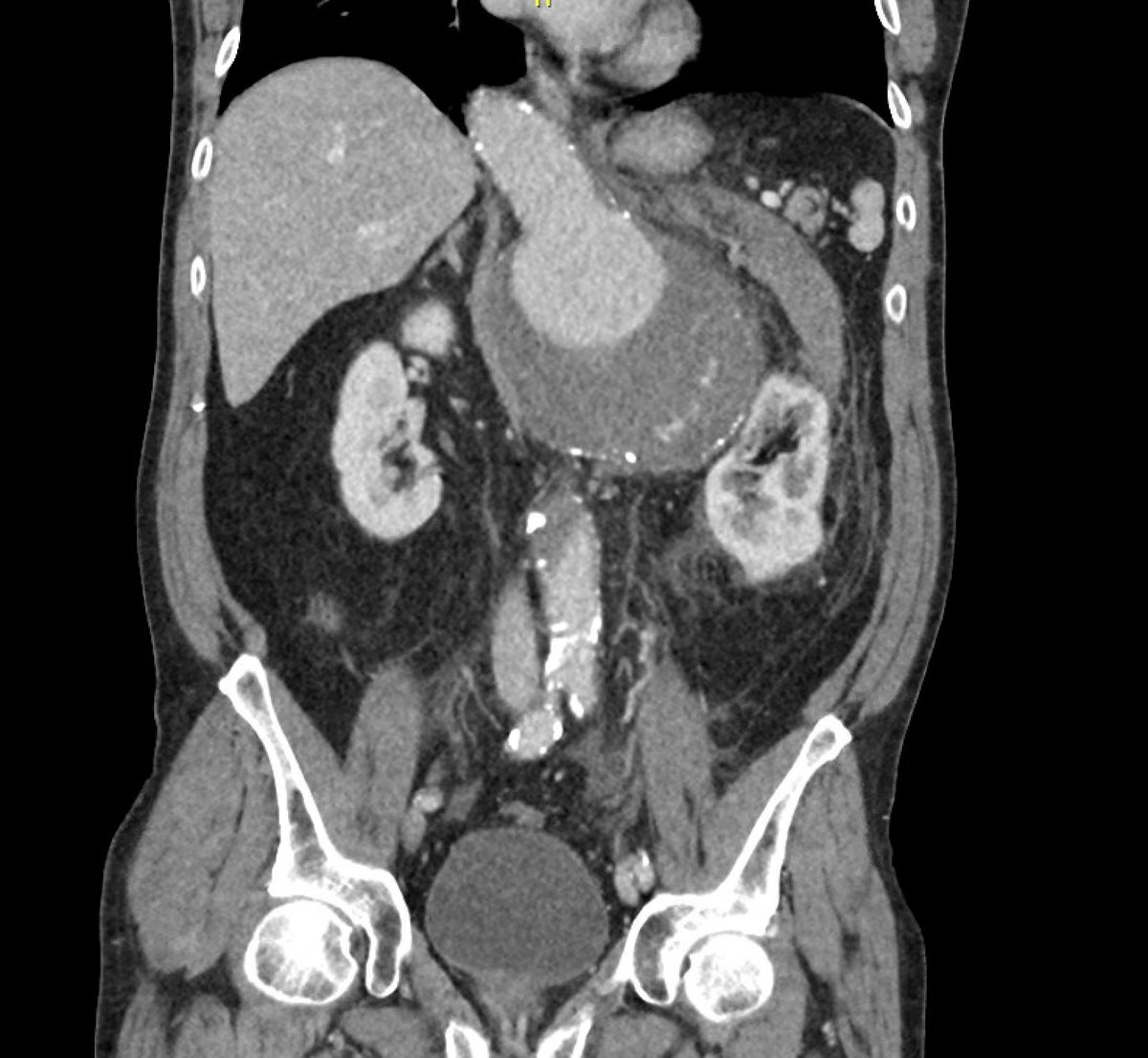 approach to operative management in a relatively urgent manner ( ongoing pain ) ? #aortaed <a href="/AWBeckMD/">Adam W. Beck</a> <a href="/NimeshDesaiMD/">Nimesh Desai MD PhD</a> #rupture #aorta