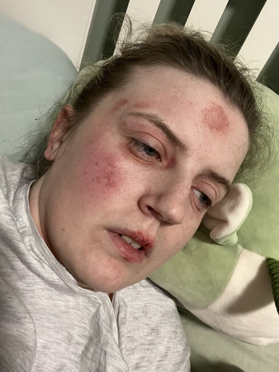 NatashaCoatesGB's tweet photo. Hey @GreggsOfficial I got given a caffeinated coffee when I ordered a decaf. I have a medical condition and haven’t been able to tolerate caffeine in years. I collapsed, ending up like this and required an ambulance. Is there someone I can talk to about this? https://t.co/vQry1NwzDO