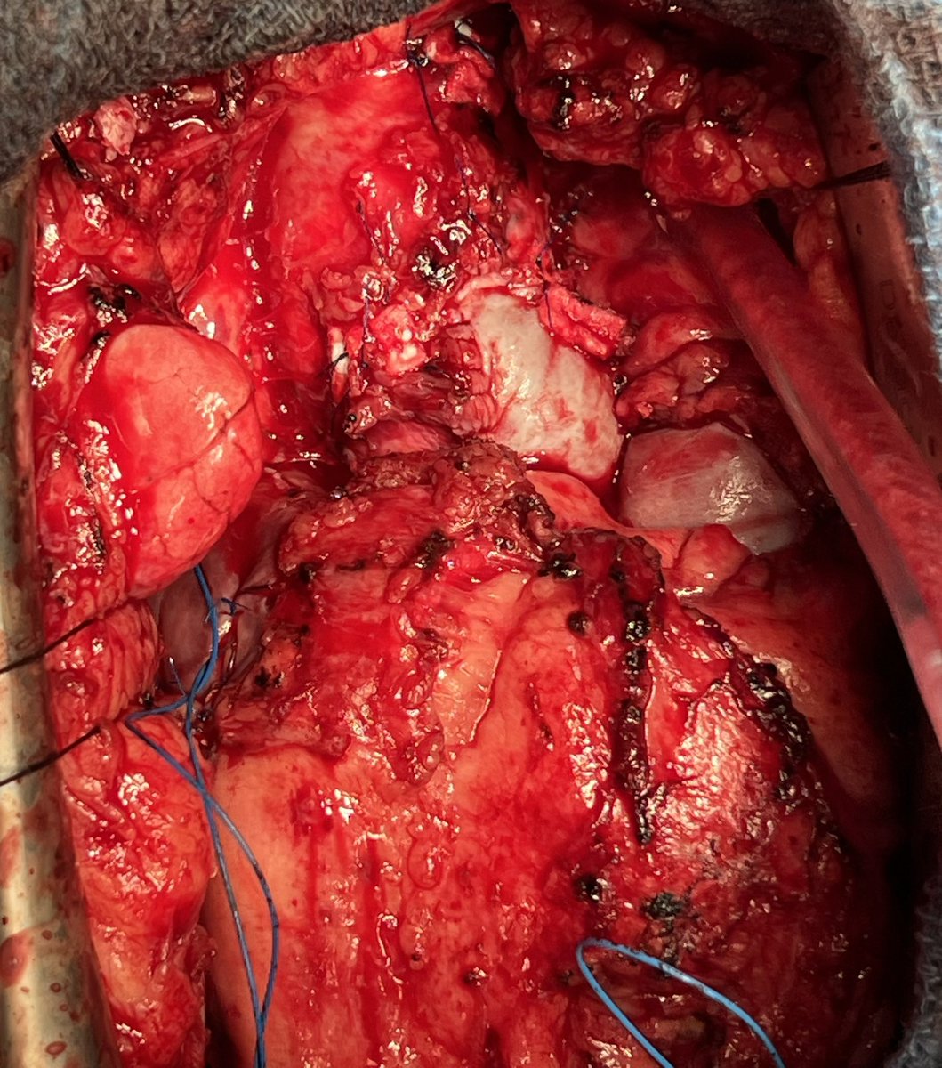 Konno method is a good option to enlarge the aortic root in the setting of re-do AVR and MVR. With Konno double patch enlarged sub-19mm annulus, 21mm aortic valve is placed with 29mm mitral tissue valve. Compared to commando, which is better?