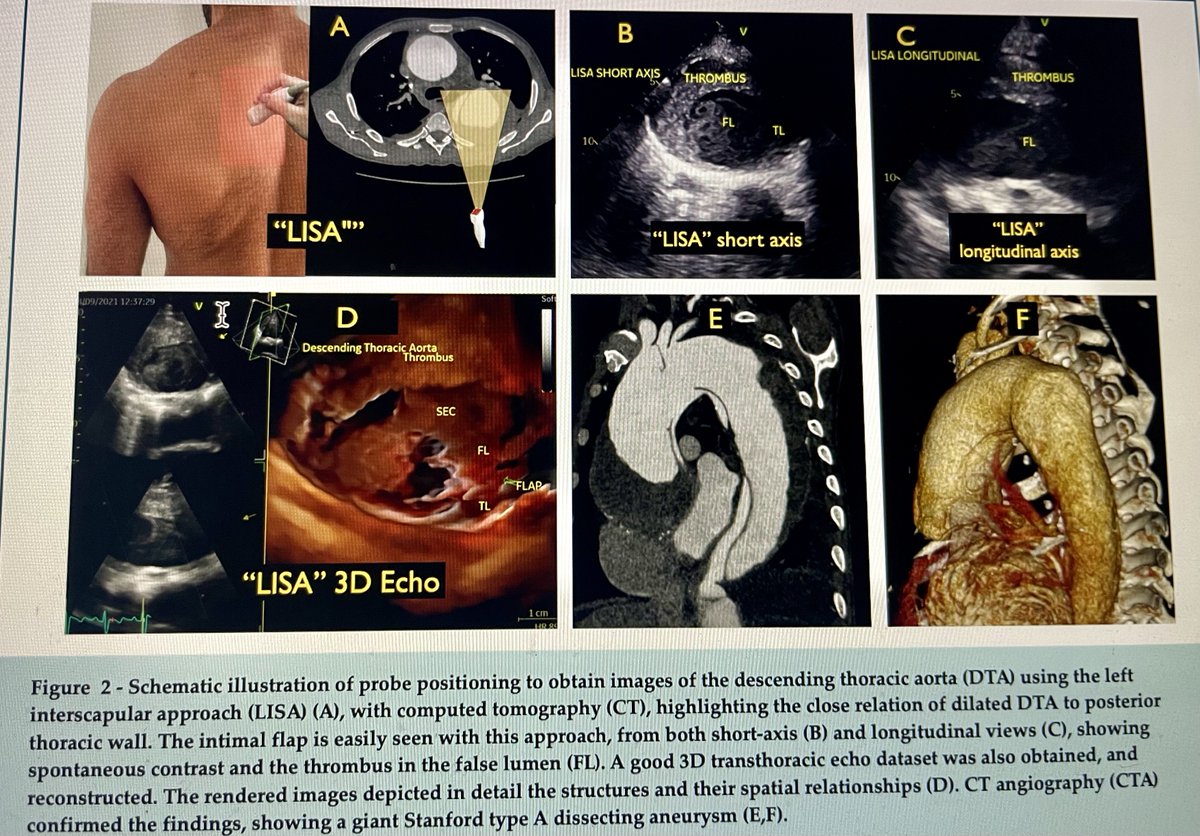 How cool to use LISA with #echofirst #POCUS to look at aortic dissection. But what is LISA? 👉 shorturl.at/kuxzK @alexsfelixecho thinking out of the box
