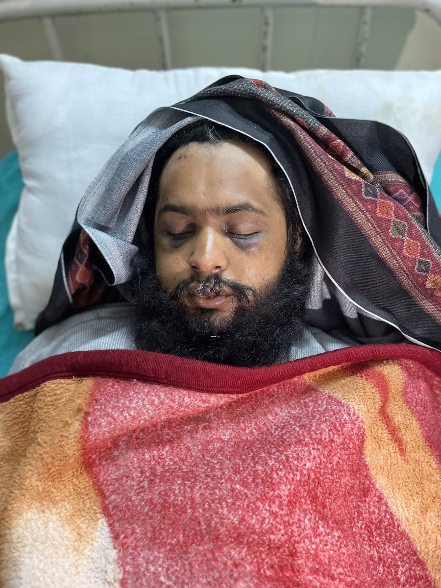 दोनों तस्वीर संगरूर के प्रीतपाल की है. दूसरी तस्वीर 21 फरवरी को ख़नौरी बॉर्डर पर हरियाणा पुलिस द्वारा सिंह को “पकड़े” जाने के बाद की है. सिंह पहली बार उस दिन #FarmerProtest में शामिल होने आए थे. 

सिंह ने जब हम मिले तो वो बोल नहीं पा रहे थे. 
स्टोरी लिंक- m.youtube.com/watch?v=229VDh…