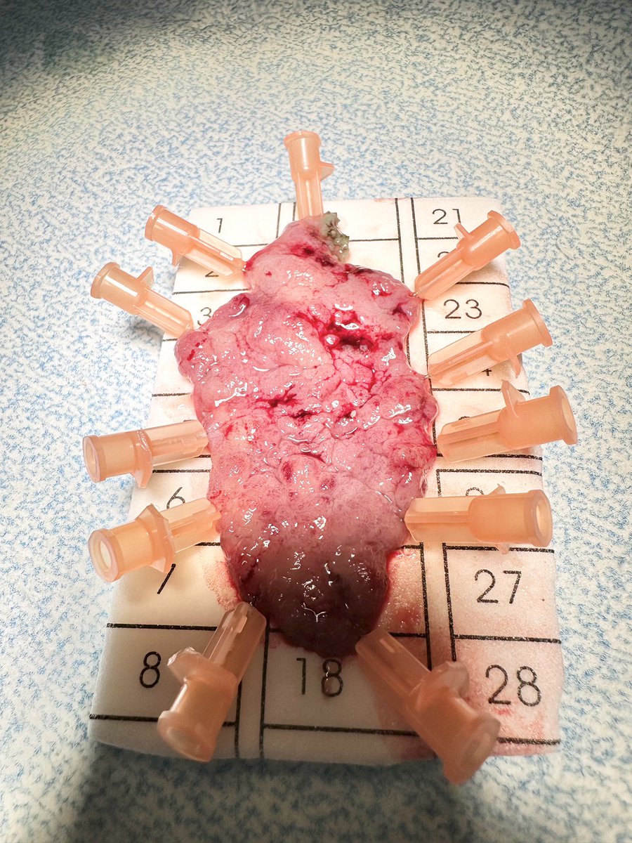 Another organ preserving endoscopic surgery at SUNY Upstate: ESD of a 10 x 6 cm, Paris IIa, mixed granular LST with a dominant nodule in the Rectum using double tunnel technique. @UpstateGastro @Dr_VishnuKumar @theganesh