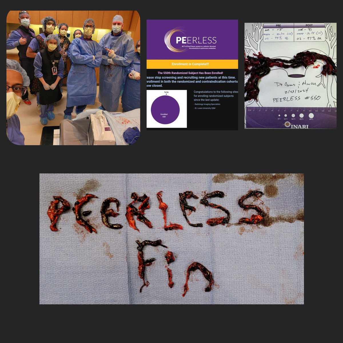 keithppereira's tweet image. #Pouring #PE's! ☔ 

5 days
9 intermediate/high risk
8 #VIrad interventions
4 clinical trial enrollments

....and YES , @SLU_VIR officially enrolled the 550th patient and CLOSED #PEERLESS , the 1st RCT comparing CDT to MT for #PulmonaryEmbolism