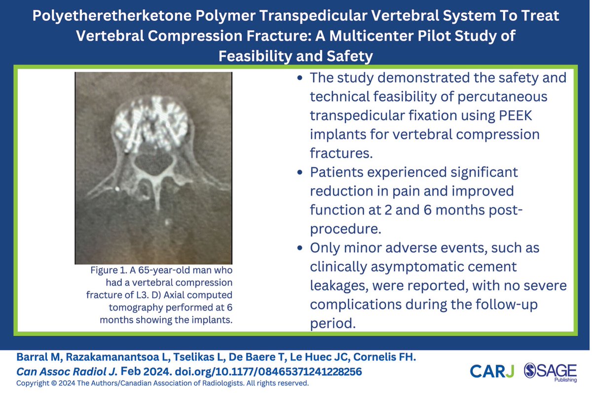 Check out this recently published multicentre pilot study which assessed the polyetheretherketone polymer transpedicular vertebral system for treating vertebral compression fractures: doi.org/10.1177/084653… @CARadiologists @SageJournals #radiology #radres