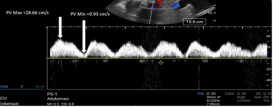 The spectral Doppler below shows the portal vein. What is the Pulsatility Index (PI), and how would the VExUS protocol categorize this portal vein? Find out by taking this weeks quiz-->forms.office.com/r/DHXFLyAasB @IUPCCM @GrahamCarlos @NephroP