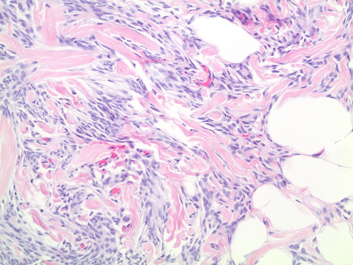 Breast - Myofibroblastoma #PathTwitter #BreastPath #PathOutPic