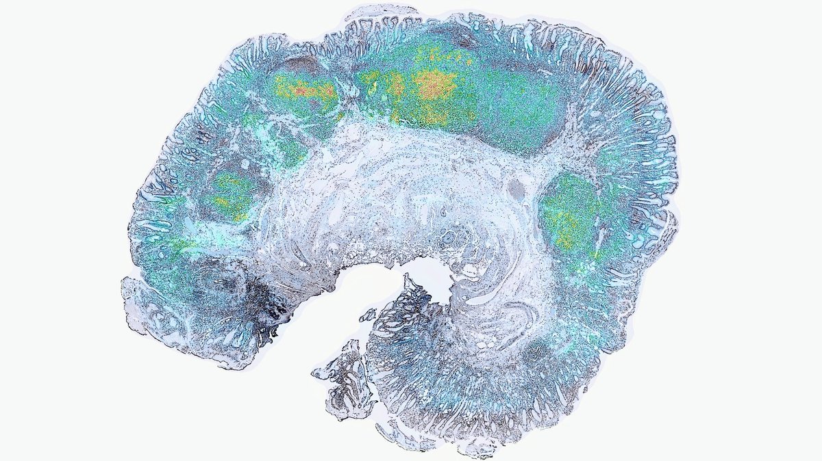 Super-resolved single-cell atlas of a human lymphoma FFPE tissue slide profiled using our latest Patho-DBiT technology and the novel pipeline iStar developed by @DrMingyaoLi . Just too psyched to not share 🤩🤩