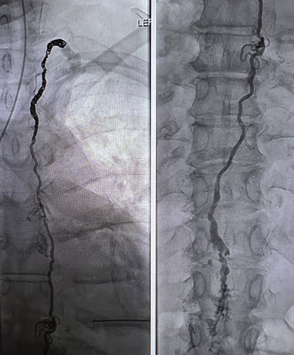 joseph gemmete (@joeyg132513) on Twitter photo My ADHD kicked in, and I could not wait for opacification of the Cisterna chyli, so punctured it blindly based on CT. Max Itkins needle with the hook stayed in the LN - SureAx Medical LNX needle. Chylothorax resolved. #iirad <a href="/SIRspecialists/">Society of Interventional Radiology</a> <a href="/cirsesociety/">CIRSE</a> <a href="/pairsmedia/">PAIRS</a> <a href="/BSIR_News/">The British Society of Interventional Radiology</a> My ADHD kicked in, and I could not wait for opacification of the Cisterna chyli, so punctured it blindly based on CT. Max Itkins needle with the hook stayed in the LN - SureAx Medical LNX needle. Chylothorax resolved. #iirad <a href="/SIRspecialists/">Society of Interventional Radiology</a> <a href="/cirsesociety/">CIRSE</a> <a href="/pairsmedia/">PAIRS</a> <a href="/BSIR_News/">The British Society of Interventional Radiology</a>