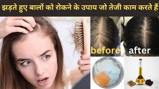 पिछले पोस्ट में हमने बालों के झड़ने के कारण को देखा था आज के पोस्ट में हम बालों के झड़ने और डैंड्रफ के उपचार को देखेंगे I

1. जीवनशैली में बदलाव 

आहार एवं पोषण:आयरन, बायोटिन और जिंक जैसे विटामिन और खनिजों से भरपूर संतुलित आहार बालों के स्वास्थ्य के लिए महत्वपूर्ण है। कम वसा वाला