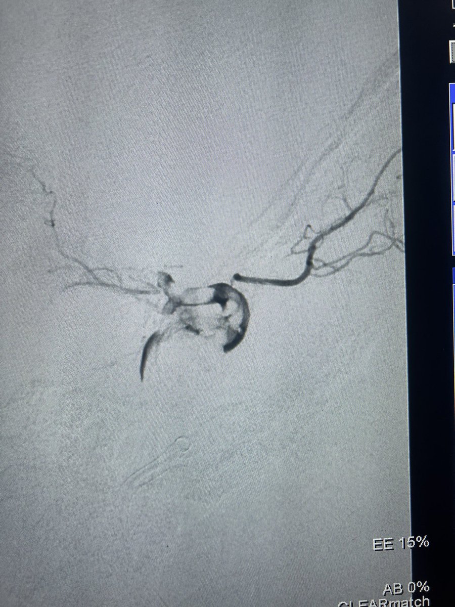 1/3
#Traumatic cca dissection with ica, mca and aca thromboembolus. 
Mech #thrombectomy, cca balloon #angioplasty yielded tici3.

#acutestroke #interventionalradiology #neurointervention #stroke