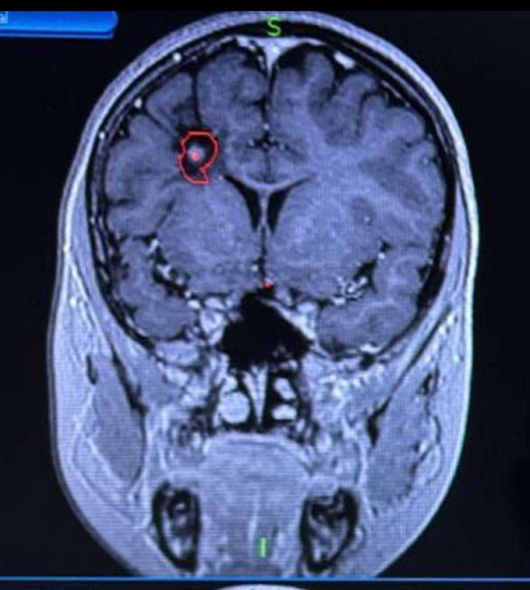 ivdsai's tweet image. బిడ్డను బతికించుకోవాలని ఓ నిరుపేద గిరిజన తల్లి ఆరాటం. తల్లి రోజు కూలి, తండ్రి కుటుంబాన్ని వదిలేసాడు. ఇద్దరు చిన్న పిల్లలు. పెద్ద బిడ్డ భూక్య నాగరాజుకు ( 9 సంవత్సరాలు ) కొన్ని సంవత్సరాలుగా fits రావడం , స్పృహ తప్పడం జరుగుతోంది. Brain లో ట్యూమర్ గడ్డ. తల్లికి గుండె కోత. బిడ్డల కడుపు…