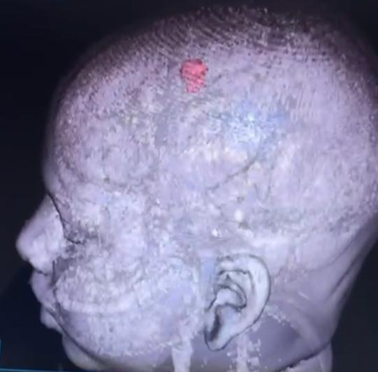 ivdsai's tweet image. బిడ్డను బతికించుకోవాలని ఓ నిరుపేద గిరిజన తల్లి ఆరాటం. తల్లి రోజు కూలి, తండ్రి కుటుంబాన్ని వదిలేసాడు. ఇద్దరు చిన్న పిల్లలు. పెద్ద బిడ్డ భూక్య నాగరాజుకు ( 9 సంవత్సరాలు ) కొన్ని సంవత్సరాలుగా fits రావడం , స్పృహ తప్పడం జరుగుతోంది. Brain లో ట్యూమర్ గడ్డ. తల్లికి గుండె కోత. బిడ్డల కడుపు…