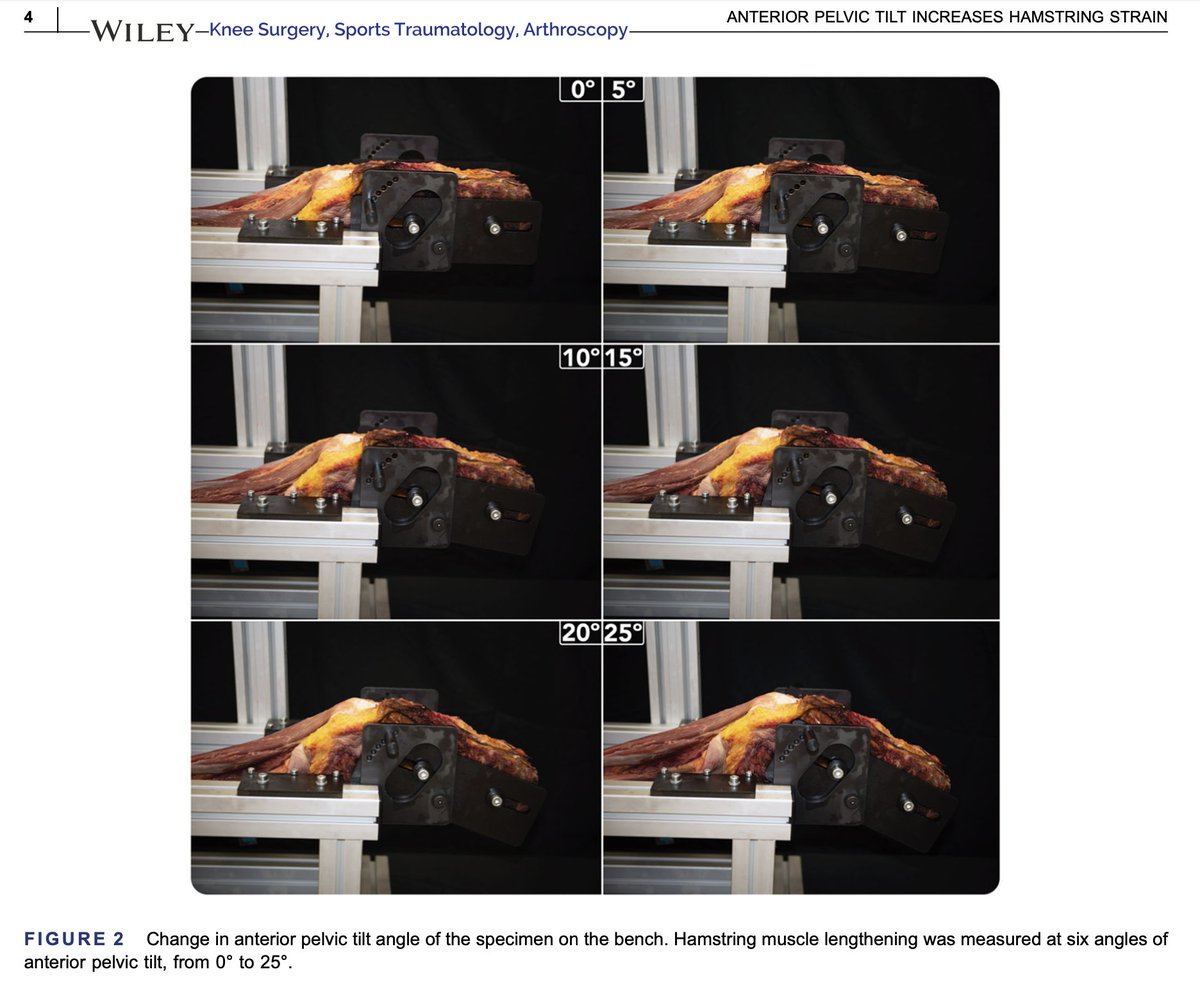 Hamstring strain 🔬🧐
Pelvis tilt is a major contributor🆕 in-vitro🦵🛠study 👏Mendiguchia &amp;al <a href="/zentrumsport/">ZENTRUM SPORT</a> 
pubmed.ncbi.nlm.nih.gov/38391038/
Great discussion points⚠️hip/pelvis confusion
Supports our effective training intervention (only 5° may change things...)
researchgate.net/publication/35…