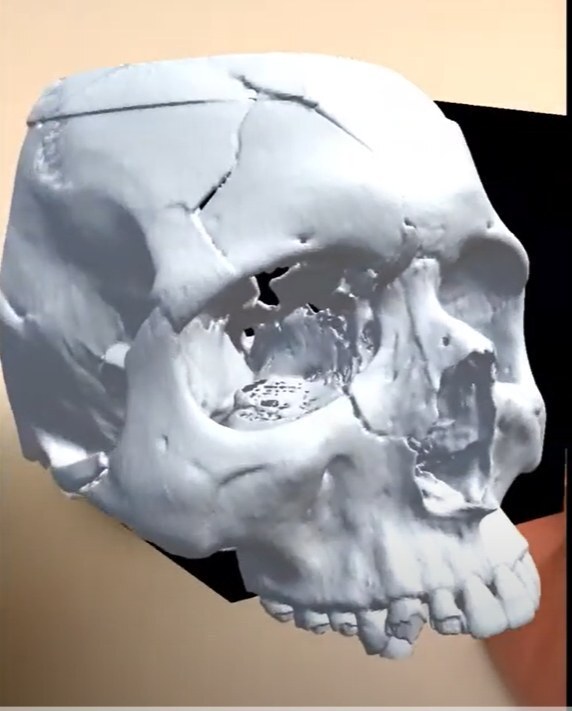 3DHEALS (@3dheals) on Twitter photo Congrats to <a href="/SiraMedical/">Sira Medical</a> on #FDAClearance for #AugmentedReality #Preoperative #SurgicalPlanning Software #ARVR #Pitch3D
prn.to/4bKZCi3 Congrats to <a href="/SiraMedical/">Sira Medical</a> on #FDAClearance for #AugmentedReality #Preoperative #SurgicalPlanning Software #ARVR #Pitch3D
prn.to/4bKZCi3