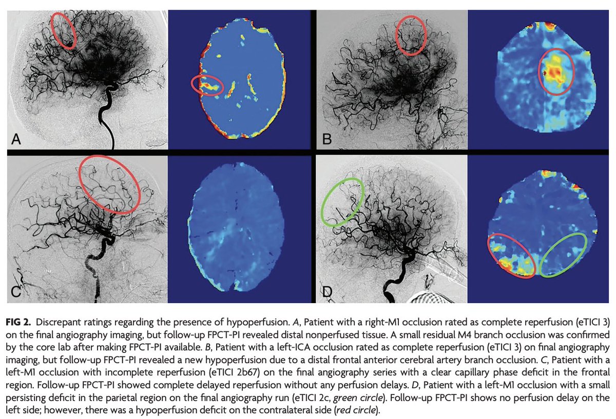 'Value of Immediate Flat Panel Perfusion Imaging after Endovascular Therapy (AFTERMATH): A Proof of Concept Study' doi.org/10.3174/ajnr.A… @adnan_mujanovic @chris_kurmann @TDoborcky @Eikeip @TotoMynell @DavidSeiffge @CheesmakerMD @NguyenThanhMD @gboulouis; @StrokeBern