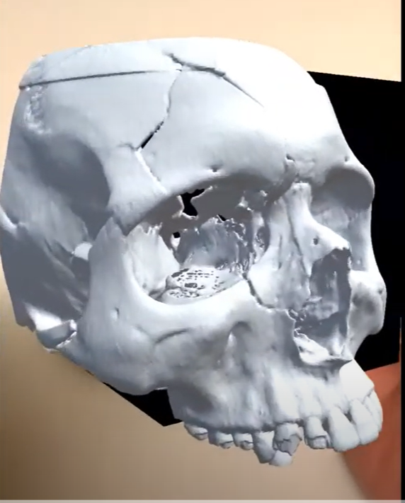 3dheals's tweet photo. Congrats to @SiraMedical on #FDAClearance for #AugmentedReality #Preoperative #SurgicalPlanning Software #ARVR #Pitch3D 
https://t.co/nCdV2s9IPI https://t.co/k78Ju7oJYr