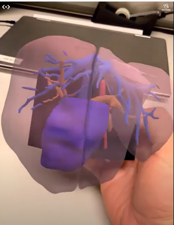 3dheals's tweet photo. Congrats to @SiraMedical on #FDAClearance for #AugmentedReality #Preoperative #SurgicalPlanning Software #ARVR #Pitch3D 
https://t.co/nCdV2s9IPI https://t.co/k78Ju7oJYr