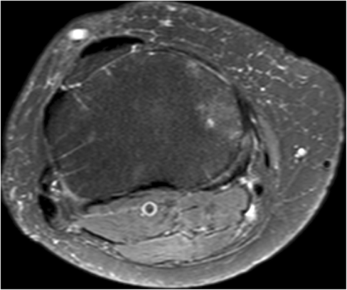 normal upper tibial vascular marks, medially lost vascular marks in osteoarthritis josr-online.biomedcentral.com/articles/10.11…