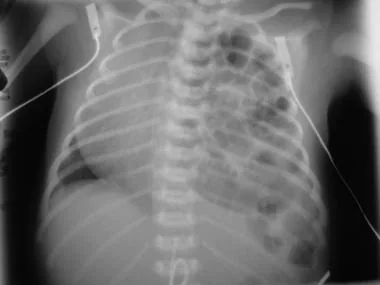 Congenital Diaphragmatic Hernia (CDH) xray medscape.com