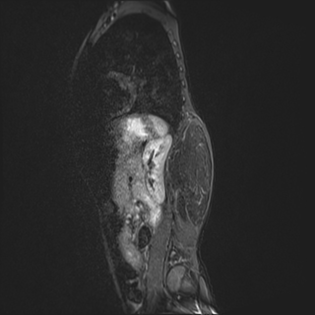paraspinal lipoma : high signal on T1 and T2 weighted imaging of loss of signal after fat suppression radiopaedia.org