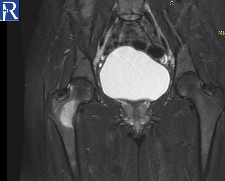 A 20-year-old female patient was admitted with nocturnal pain relieved by analgesics in her right hip.#radiology #mskradiology #mskrad #radres #futureradres #radtwitter #orthotwitter #medstudent #MedTwitter