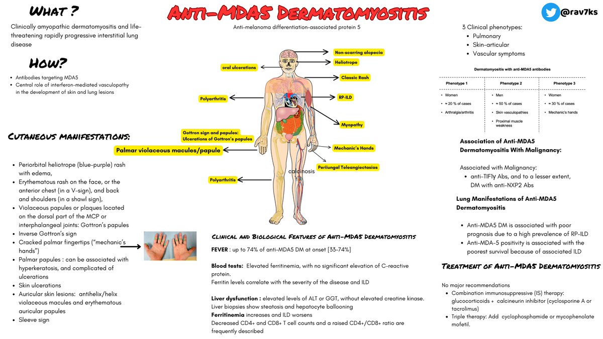 Anti-MDA5 DM is characterized by autoantibodies targeting MDA5. Often manifests with rapidly progressive ILD and skin manifestations. There are 3 Clinical phenotypes: -Pulmonary -Skin-articular -Vascular symptoms #Dermatomyositis #MDA5 #MedTwitter